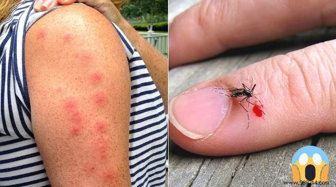 5 Time-Tested Grandma s Remedies to Relieve Insect Bites Naturally