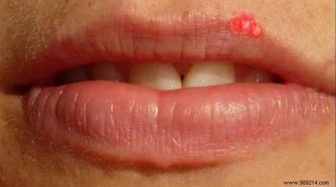 Banish Cold Sores in 30 Minutes: My Proven Green Clay Remedy