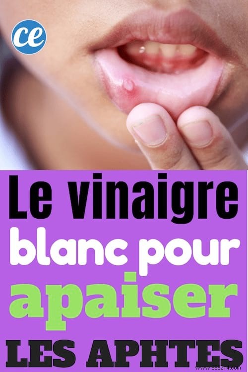 Soothe Painful Canker Sores Naturally with White Vinegar: A Proven Home Remedy
