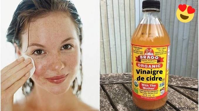 4 Proven Apple Cider Vinegar Remedies for Acne, Eczema, Cold Sores, and Itching