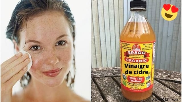 4 Proven Apple Cider Vinegar Remedies for Acne, Eczema, Cold Sores, and Itching
