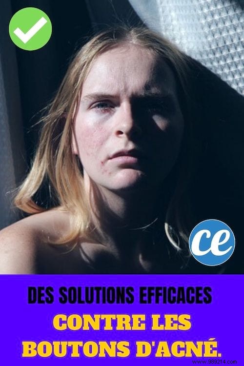 Proven Strategies to Combat Acne and Achieve Clearer Skin