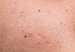 Remove Blackheads Naturally: Proven Lemon Remedy for Clearer Skin