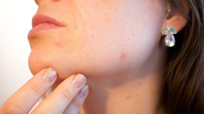 8 Proven Tips to Prevent and Effectively Manage Acne
