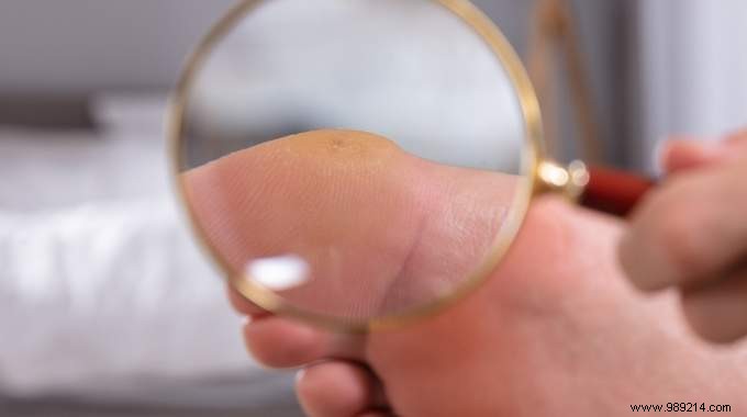 Prevent Plantar Warts in Campsite Showers: The Simple Towel Trick