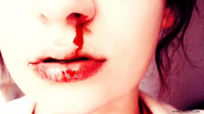 How to Stop a Nosebleed in Just 5 Minutes: A Proven, Simple Trick