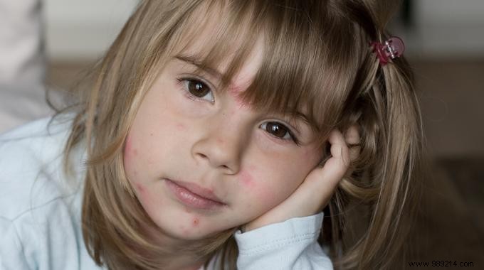 Natural Linden Bath Remedy: Soothe Chickenpox Itch Effectively