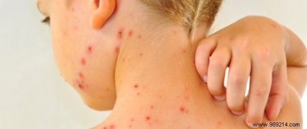 Natural Ways to Soothe Chickenpox Itch: Safe Recipes from a Parent s Experience