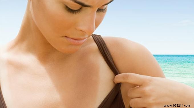 Expert Natural Remedy: Soothe Sunburn Fast with Aloe Vera Ice Cubes