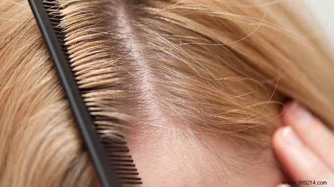 Grandma s Proven Salt Remedy: Banish Dandruff Naturally and Effectively