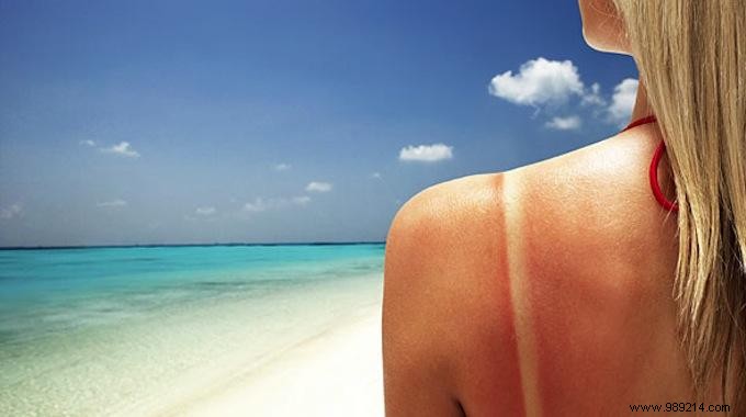 Yogurt: A Proven Natural Remedy for Soothing Sunburn Pain and Redness