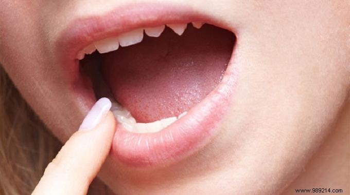 Natural Canker Sore Relief: Propolis, the Effective Bee-Made Remedy