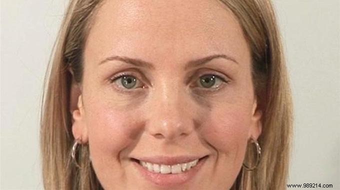 Banish Dark Circles Naturally: A Proven, Simple Tip