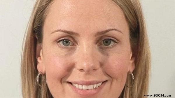 Banish Dark Circles Naturally: A Proven, Simple Tip