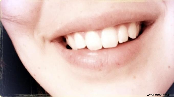 7 Effective Home Remedies for Oral Thrush: My Tried-and-Tested Natural Relief