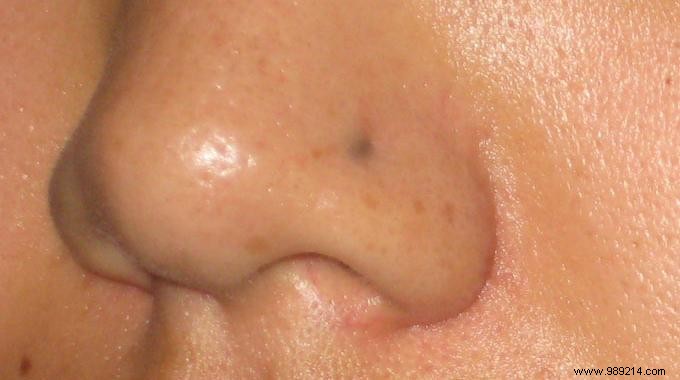 Natural Watercress Remedy: A Simple Way to Combat Blackheads