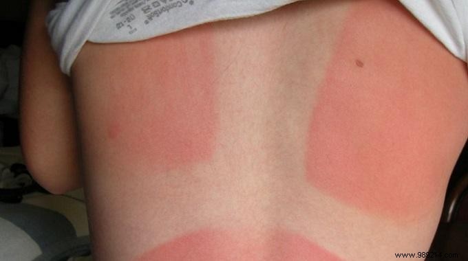 3 Proven Natural Remedies to Soothe Sunburn Pain at Home