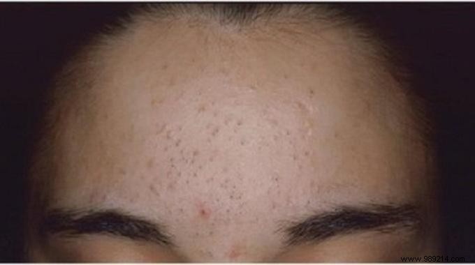 Natural Clove Lotion: An Effective, Time-Tested Remedy for Blackheads