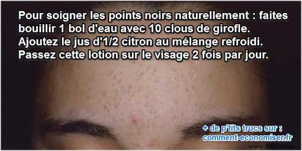 Natural Clove Lotion: An Effective, Time-Tested Remedy for Blackheads