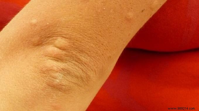 Natural Lemon Remedy: Quick Relief for Insect Bites