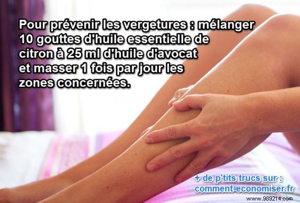 Prevent Stretch Marks Naturally: Proven Lemon and Avocado Oil Remedy