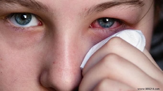 Effective Natural Honey Remedy for Conjunctivitis Relief