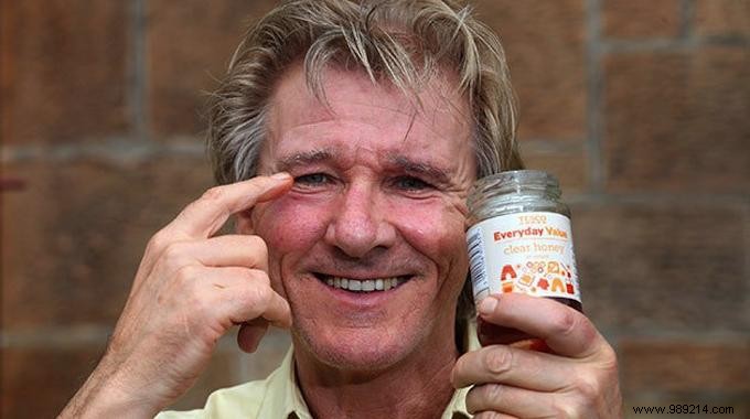 How Honey Can Naturally Soothe Conjunctivitis Symptoms: A Trusted Home Remedy