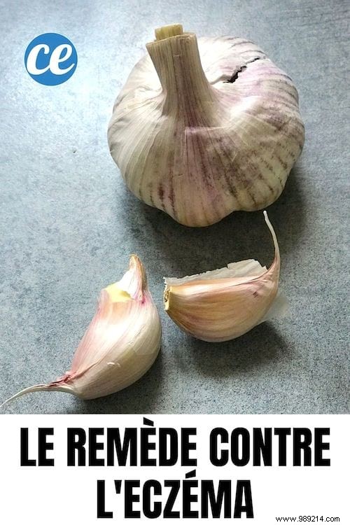 Natural Garlic Remedy for Eczema: A Trusted Grandmother s Solution