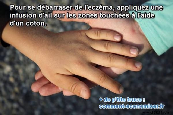 Natural Garlic Remedy for Eczema: A Trusted Grandmother s Solution