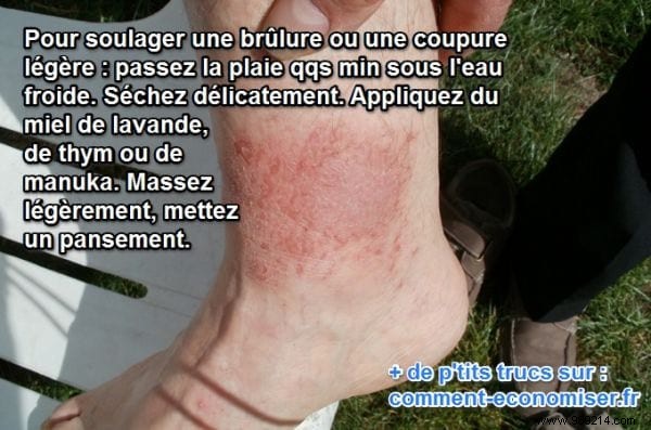 Honey: The Science-Backed, Hospital-Used Natural Remedy for Minor Burns