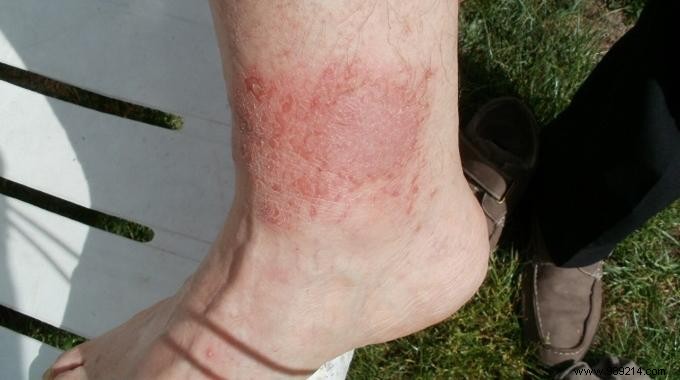 Honey: The Science-Backed, Hospital-Used Natural Remedy for Minor Burns