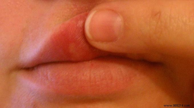 Effective Garlic Remedy: Banish Cold Sores on Lips in Days