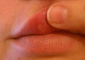Effective Garlic Remedy: Banish Cold Sores on Lips in Days