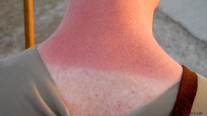 Quick Sunburn Relief: Lemon and Honey Natural Remedy