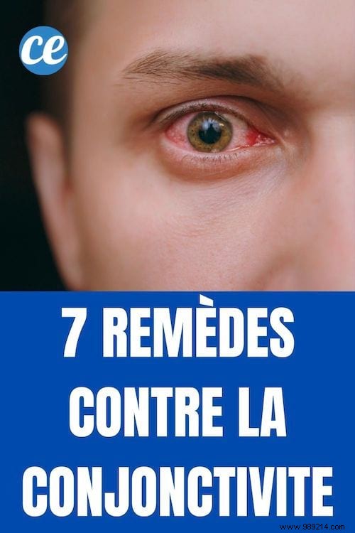 7 Proven Natural Remedies for Quick Conjunctivitis Relief at Home