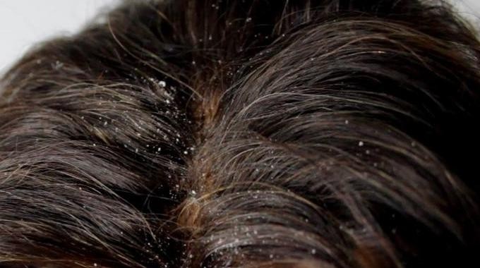 Eliminate Dandruff Naturally: Proven Apple Cider Vinegar Hair Rinse Recipe