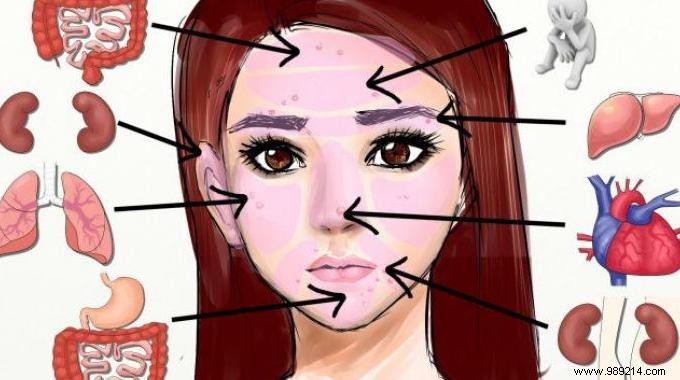 What the Location of Your Pimples Reveals About Your Health
