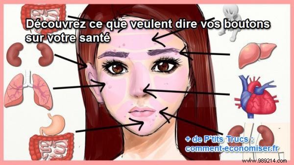 What the Location of Your Pimples Reveals About Your Health