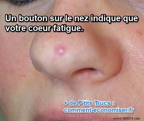 What the Location of Your Pimples Reveals About Your Health