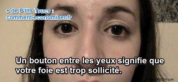 What the Location of Your Pimples Reveals About Your Health