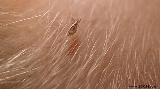 10 Proven Natural Remedies for Head Lice: Safe, Effective Home Treatments