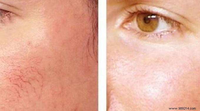 Grandmother s Proven Essential Oil Massage for Rosacea Relief