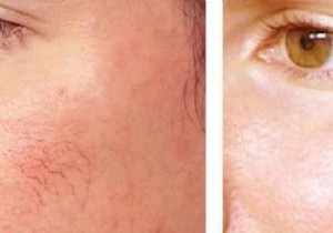 Grandmother s Proven Essential Oil Massage for Rosacea Relief