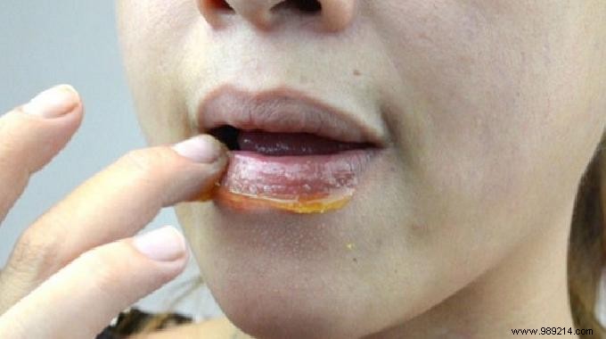Heal Chapped Lips Naturally with Honey: A Proven Remedy