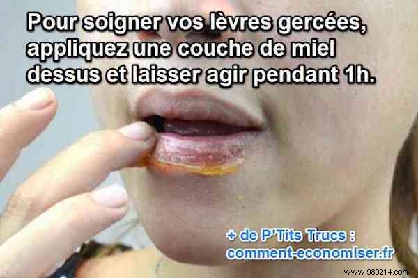 Heal Chapped Lips Naturally with Honey: A Proven Remedy