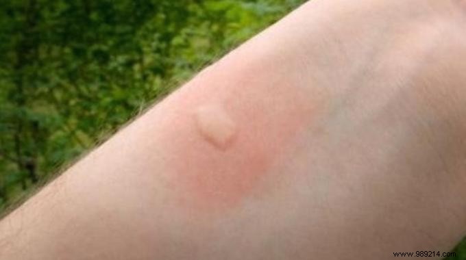 Proven Baking Soda Paste for Fast Mosquito Bite Relief