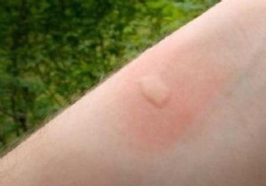 Proven Baking Soda Paste for Fast Mosquito Bite Relief