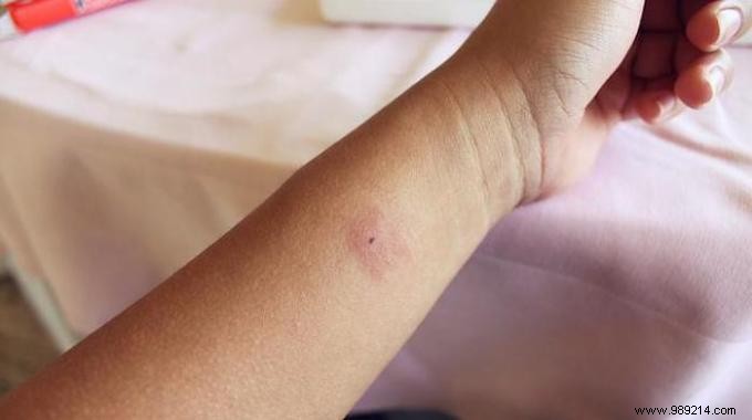 33 Proven Home Remedies to Quickly Soothe Mosquito Bites