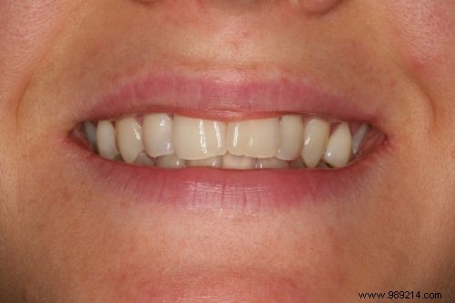 Proven Grandmother s Remedy: Relieve Toothache Pain Naturally with Cloves