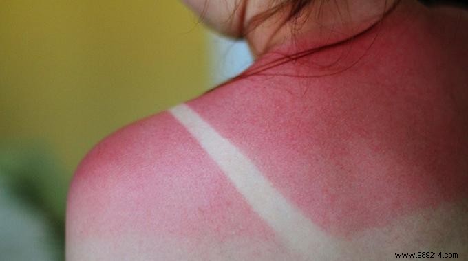 12 Proven Home Remedies to Soothe Sunburn Pain and Redness Fast